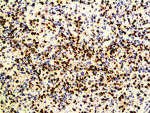 IHC of Myogenin on an FFPE Rhabdomyosarcoma Tissue